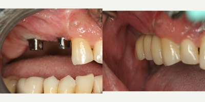 Dental Implants before and after photo