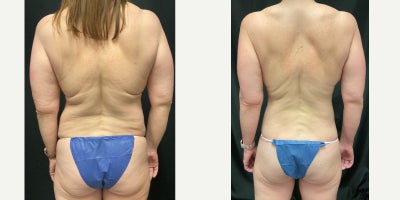 Liposuction before and after photo