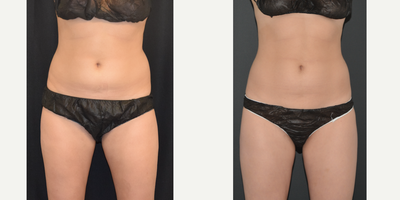 CoolSculpting before and after photo