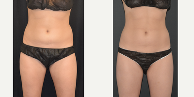 CoolSculpting before and after photo
