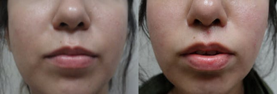 Lip Lift before and after photo