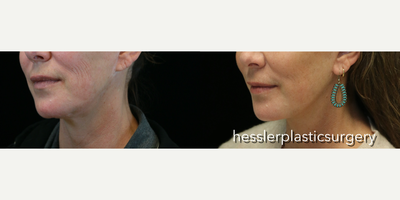 Neck Lift before and after photo
