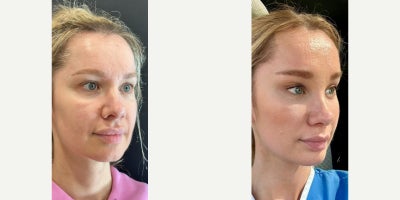 Cheek Lift before and after photo
