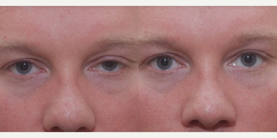 Ptosis Surgery before and after photo