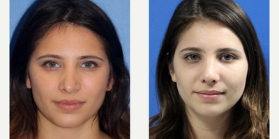 Rhinoplasty before and after photo