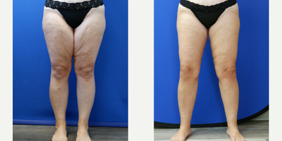 Thigh Lift before and after photo