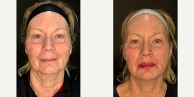 Dermal Fillers before and after photo
