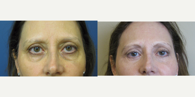 Eyelid Surgery before and after photo