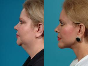 Facelift before and after photo