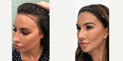 Hair Transplant before and after photo