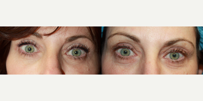 Chemical Peel before and after photo