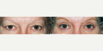 Eyelid Surgery before and after photo