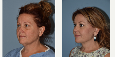 Facelift before and after photo