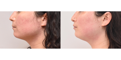 Lip Fillers before and after photo