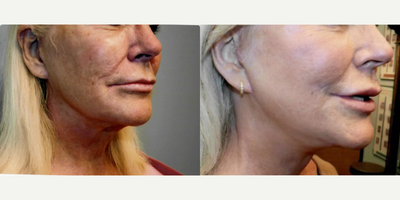 Facelift before and after photo