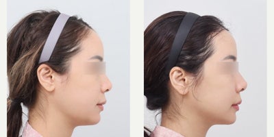 Forehead Reduction before and after photo