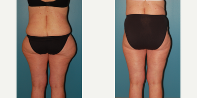Liposuction before and after photo
