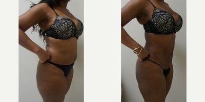 Liposuction before and after photo