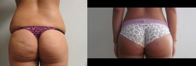 Brazilian Butt Lift before and after photo