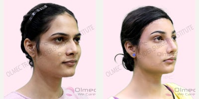 Forehead Reduction before and after photo