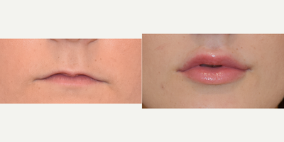 Juvederm before and after photo