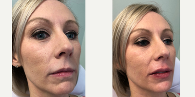 Lip Fillers before and after photo