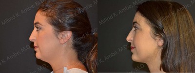 Liposuction before and after photo