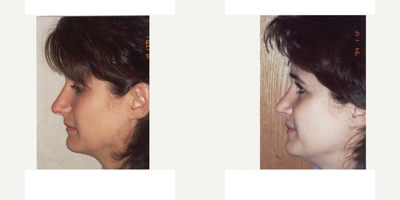 Rhinoplasty before and after photo