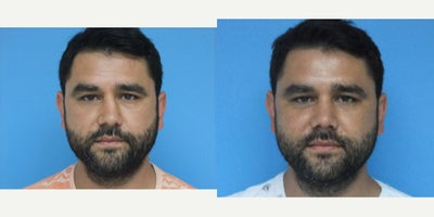 Rhinoplasty before and after photo