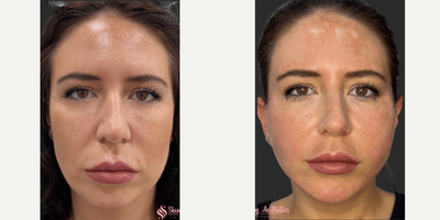Thread Lift before and after photo