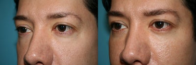 Eyelid Surgery before and after photo