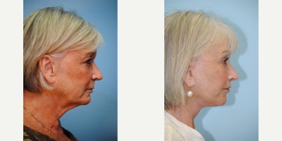 Facelift before and after photo