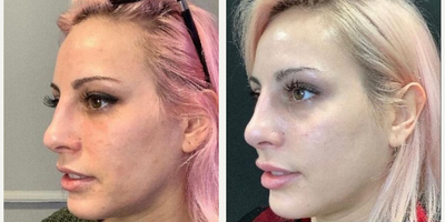 Microneedling before and after photo