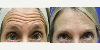 Dysport before and after photo