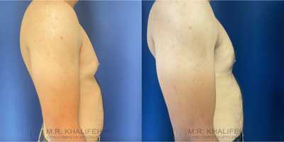 Gynecomastia Surgery before and after photo
