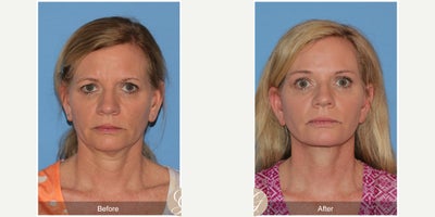 Lower Facelift before and after photo