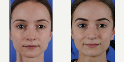Revision Rhinoplasty before and after photo