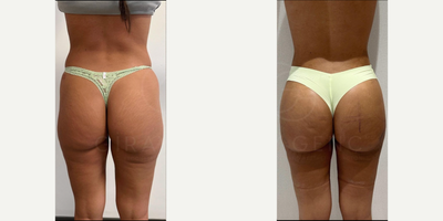 Vaser Liposuction before and after photo