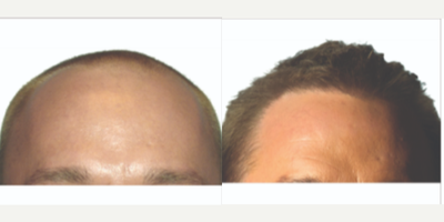 ARTAS Robotic Hair Transplant before and after photo