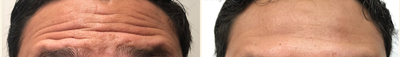 Botox before and after photo