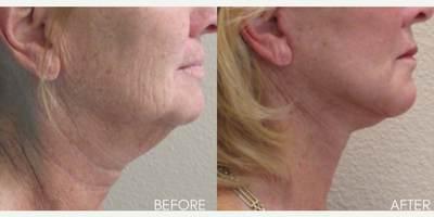 Bellafill before and after photo