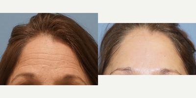 Botox before and after photo