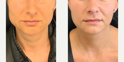 Botox before and after photo