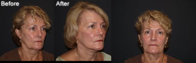 Deep Plane Facelift before and after photo