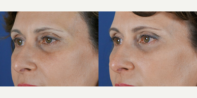 Dermal Fillers before and after photo