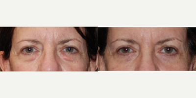 Eyelid Surgery before and after photo