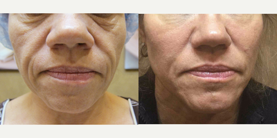 Nonsurgical Facelift before and after photo