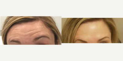 Botox before and after photo