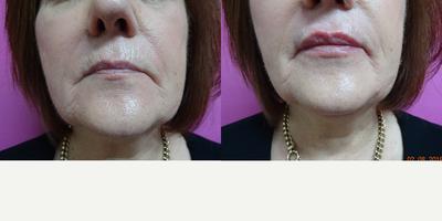 Dermal Fillers before and after photo