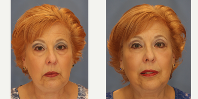 Eyelid Surgery before and after photo